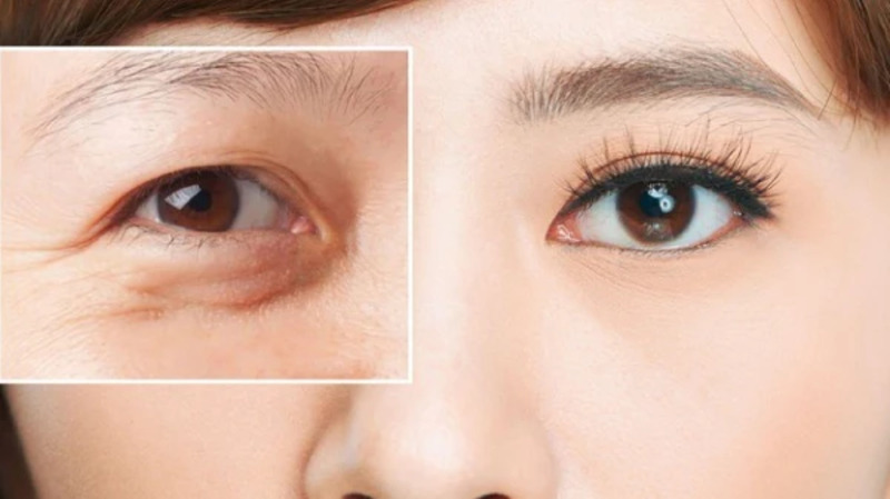 Vùng Da Mắt Bị Lão Hóa Phải Làm Sao? Bí Quyết Giữ Đôi Mắt Trẻ Trung Dài Lâu