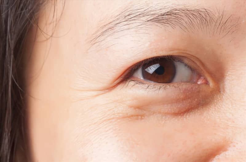 Tình trạng xuất hiện nếp nhăn ở mắt
